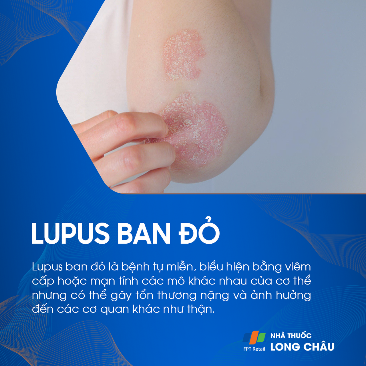 Tổn thương lupus ban đỏ trên vùng da tay – bệnh tự miễn gây viêm mô