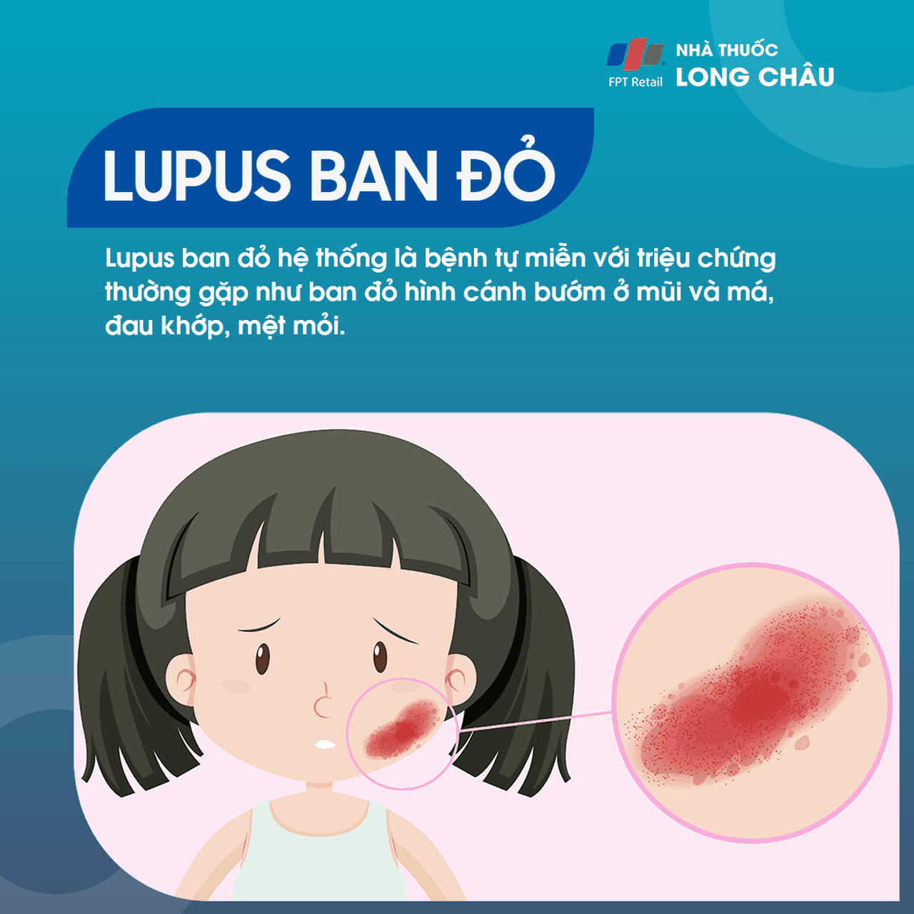 Lupus Ban Đỏ Hệ Thống 1