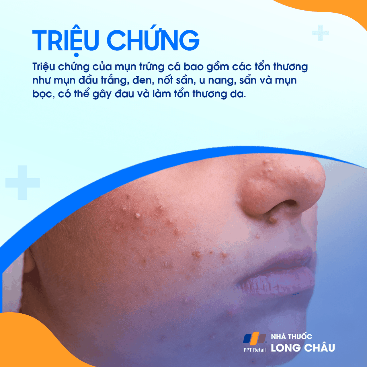 Mụn trứng cá 2