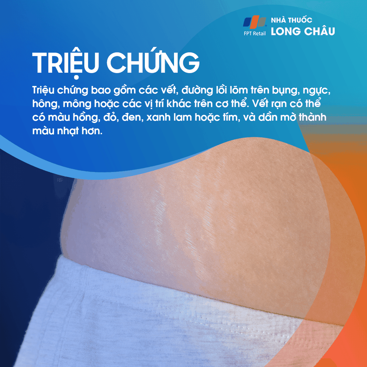 các vết rạn da đỏ hồng và trắng trên da bụng, điển hình ở phụ nữ mang thai