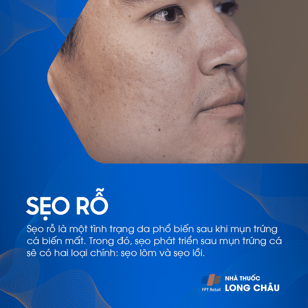 Sẹo rỗ trên mặt là hậu quả của mụn trứng cá, biểu hiện rõ ràng qua các lỗ nhỏ trên da