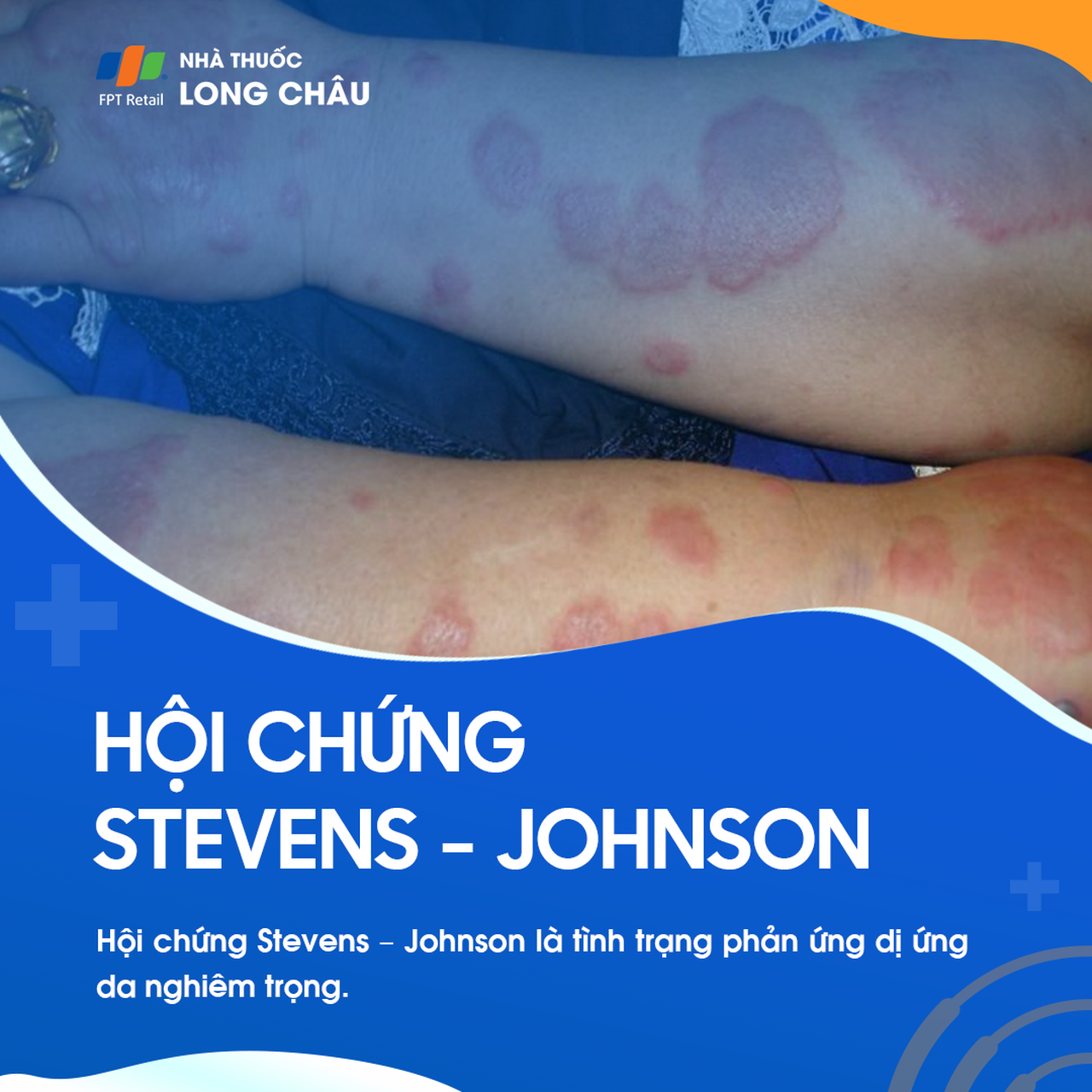 Hội chứng Stenven - Johnson 1