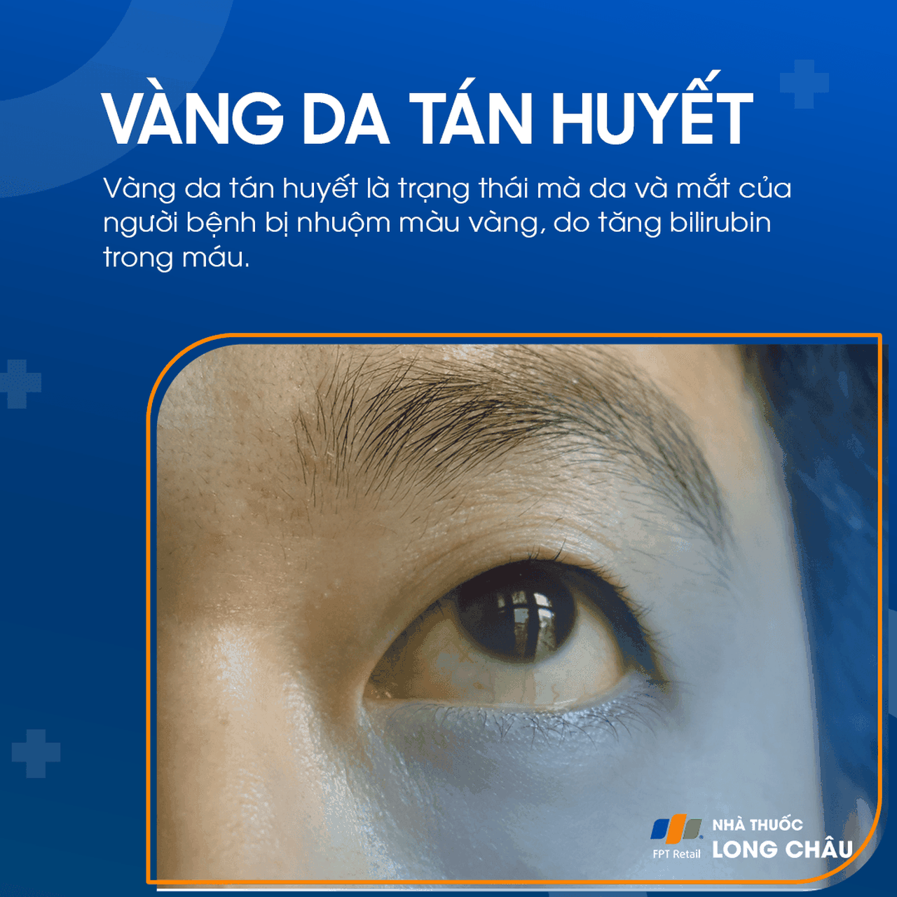 Vàng da tán huyết 1