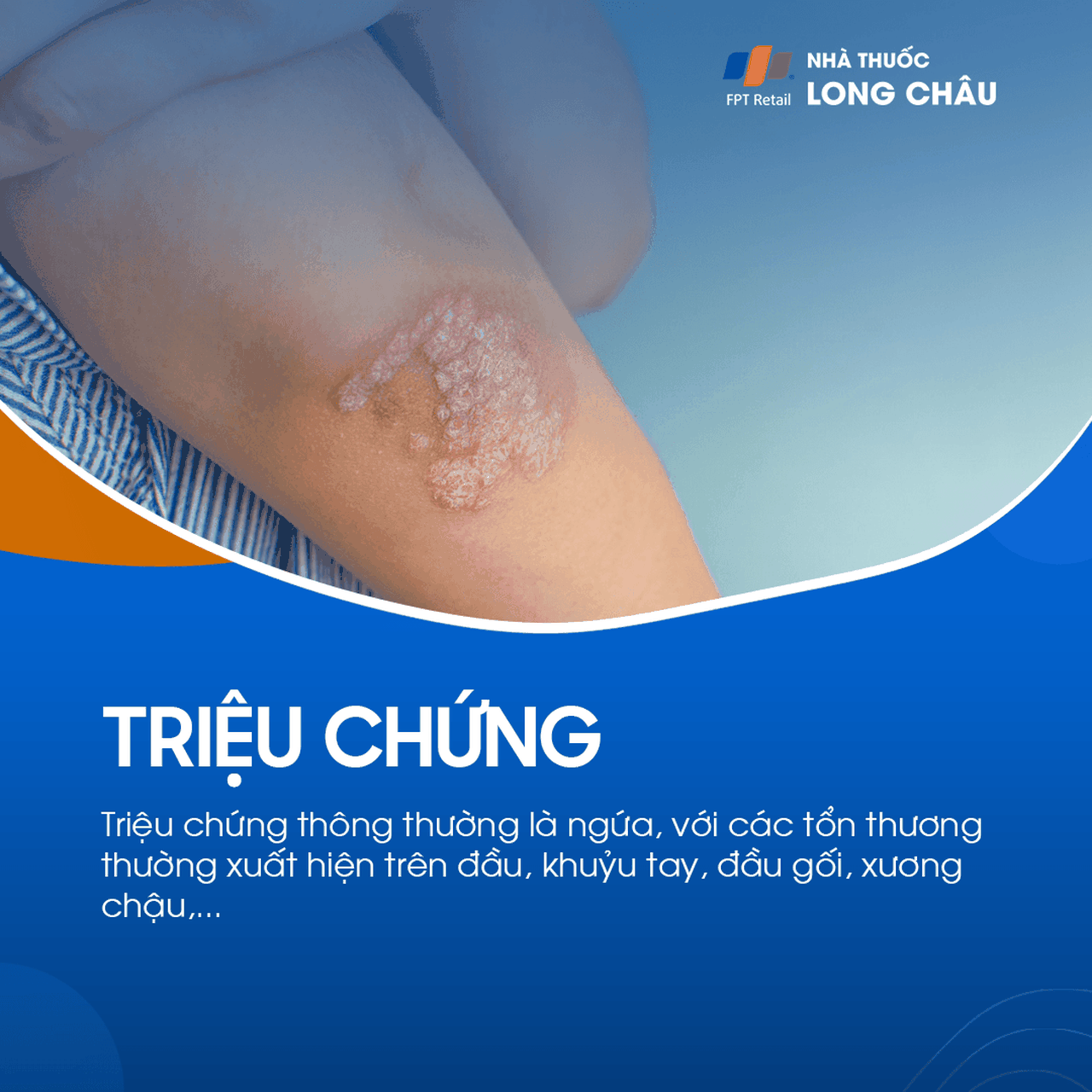 Triệu chứng thường gặp là ngứa, với tổn thương trên đầu, khuỷu tay, đầu gối, xương chậu