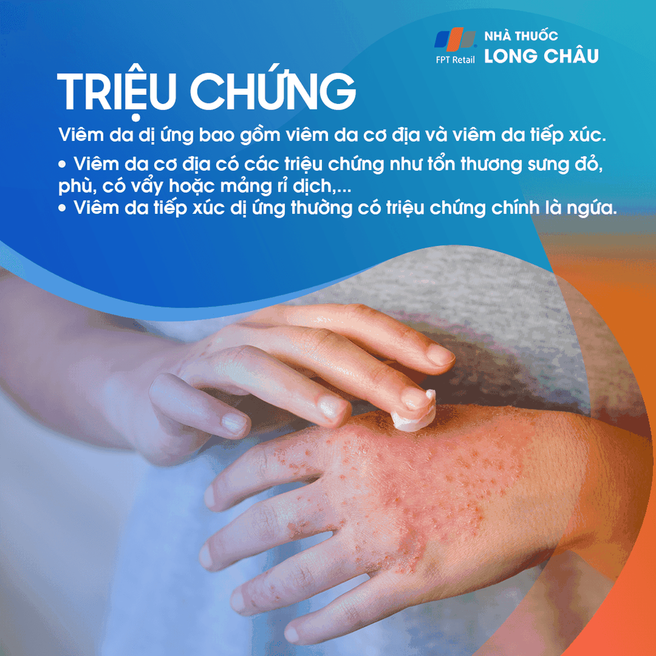 Viêm Da Dị Ứng 2