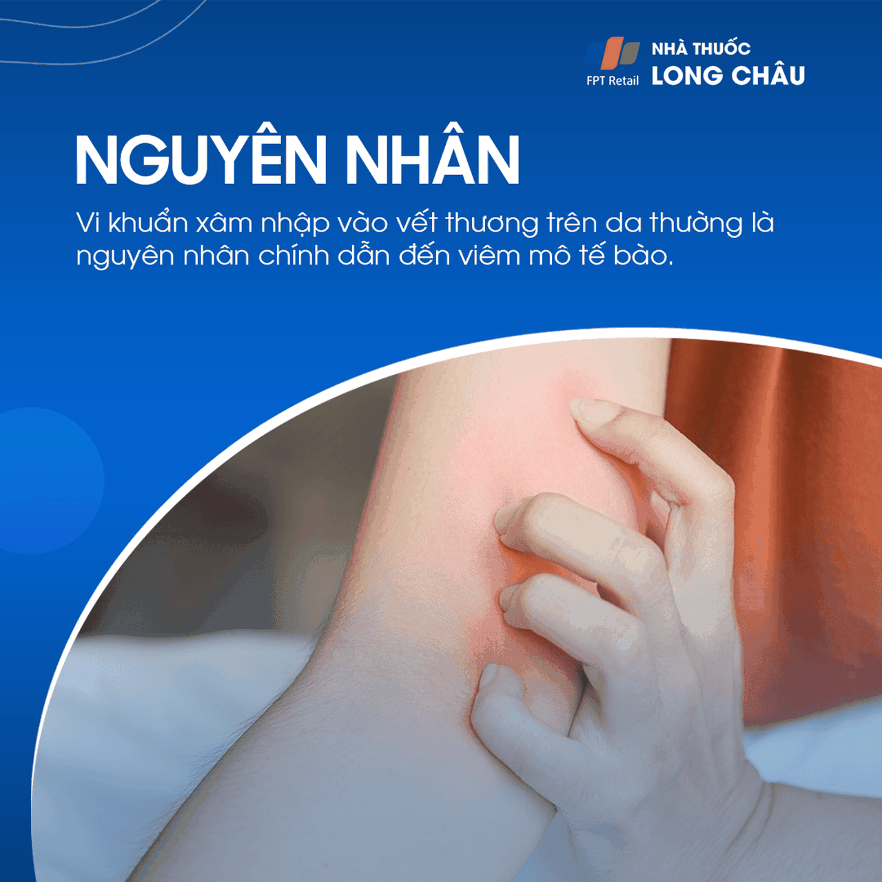 Viêm Mô Tế Bào 3