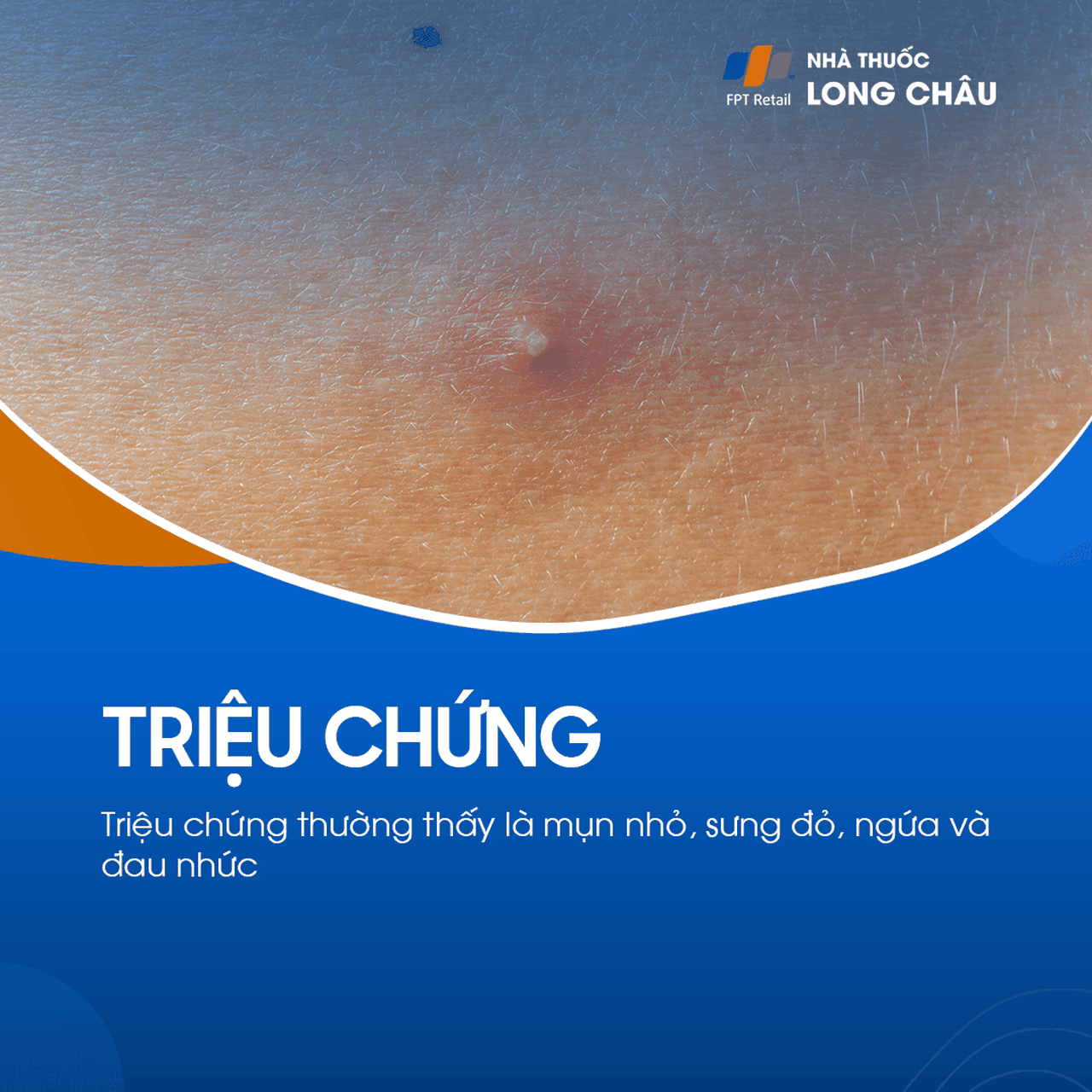 Viêm nang lông: Triệu chứng mụn mủ, đỏ và ngứa trên da