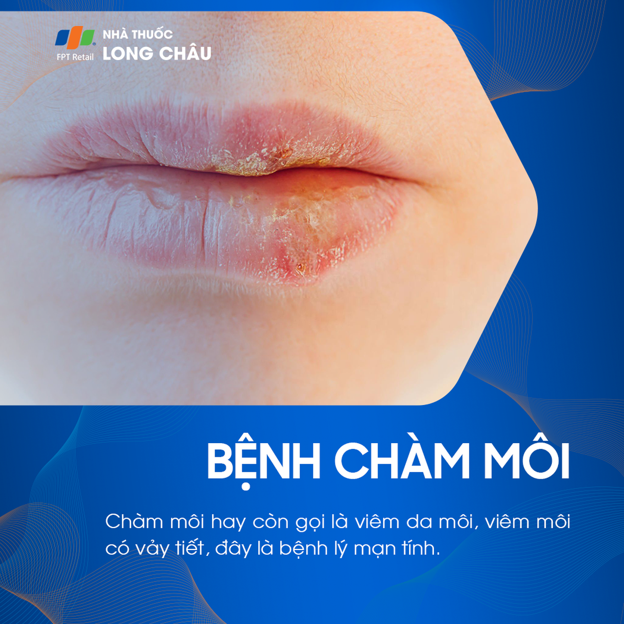 Chàm môi là gì? Nguyên nhân gây bệnh và nguyên tắc phòng ngừa