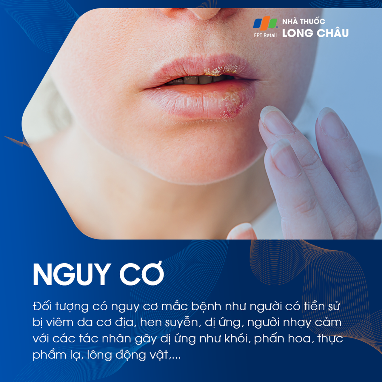 Đối tượng nguy cơ mắc chàm môi là người có da nhạy cảm và dễ bị dị ứng