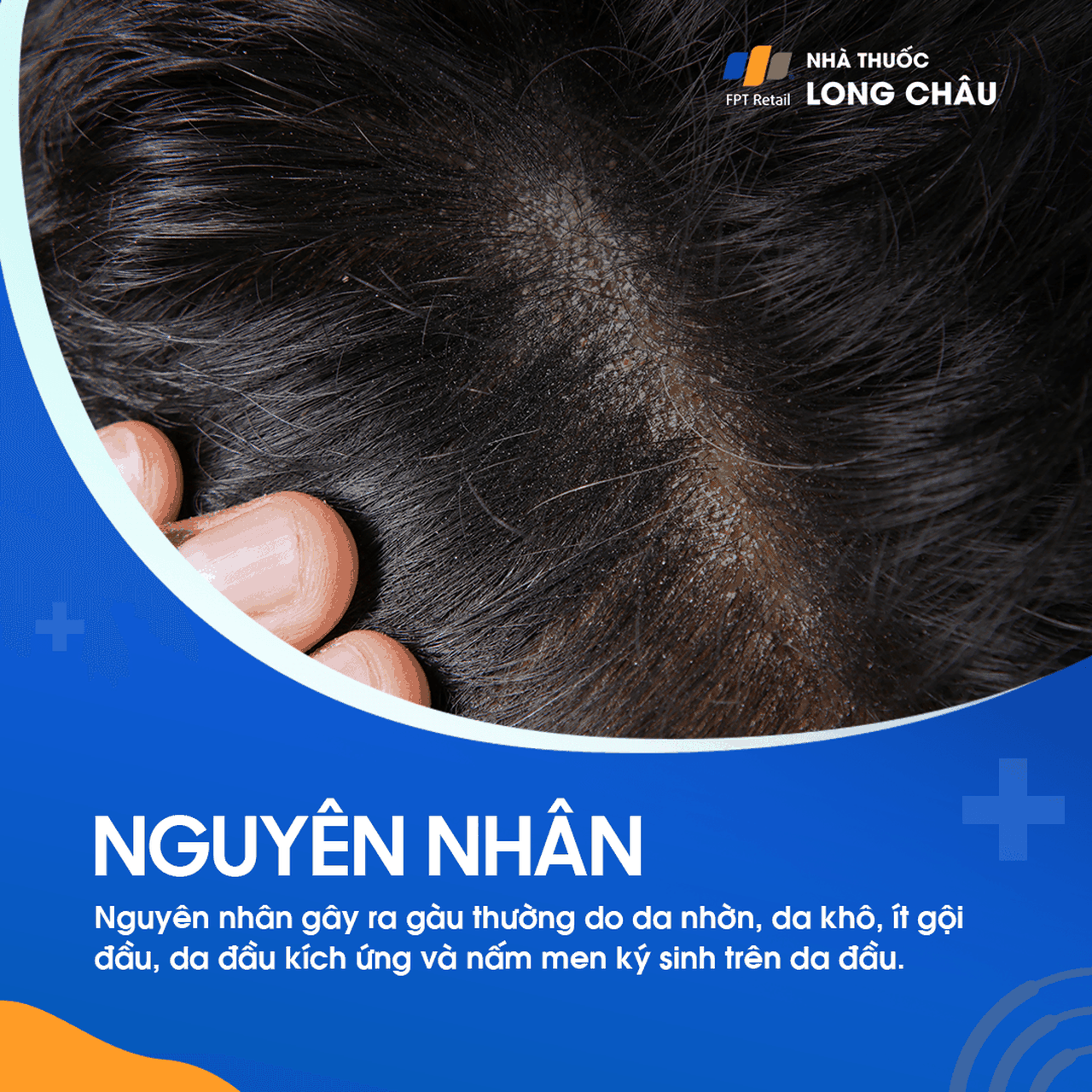 Nguyên nhân gây gầu bao gồm da đầu khô, dầu nhờn quá mức và nấm Malassezia
