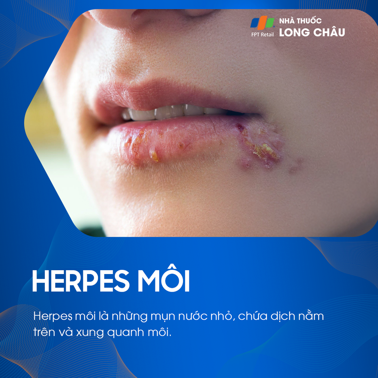 Herpes môi là bệnh gì? Nguyên nhân gây bệnh, cách điều trị và phòng ngừa