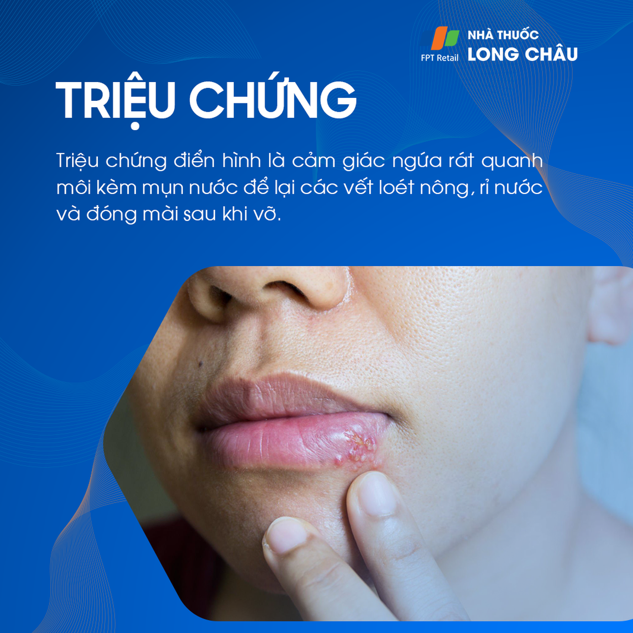 Herpes môi: Triệu chứng mụn nước, ngứa và đau rát trên môi