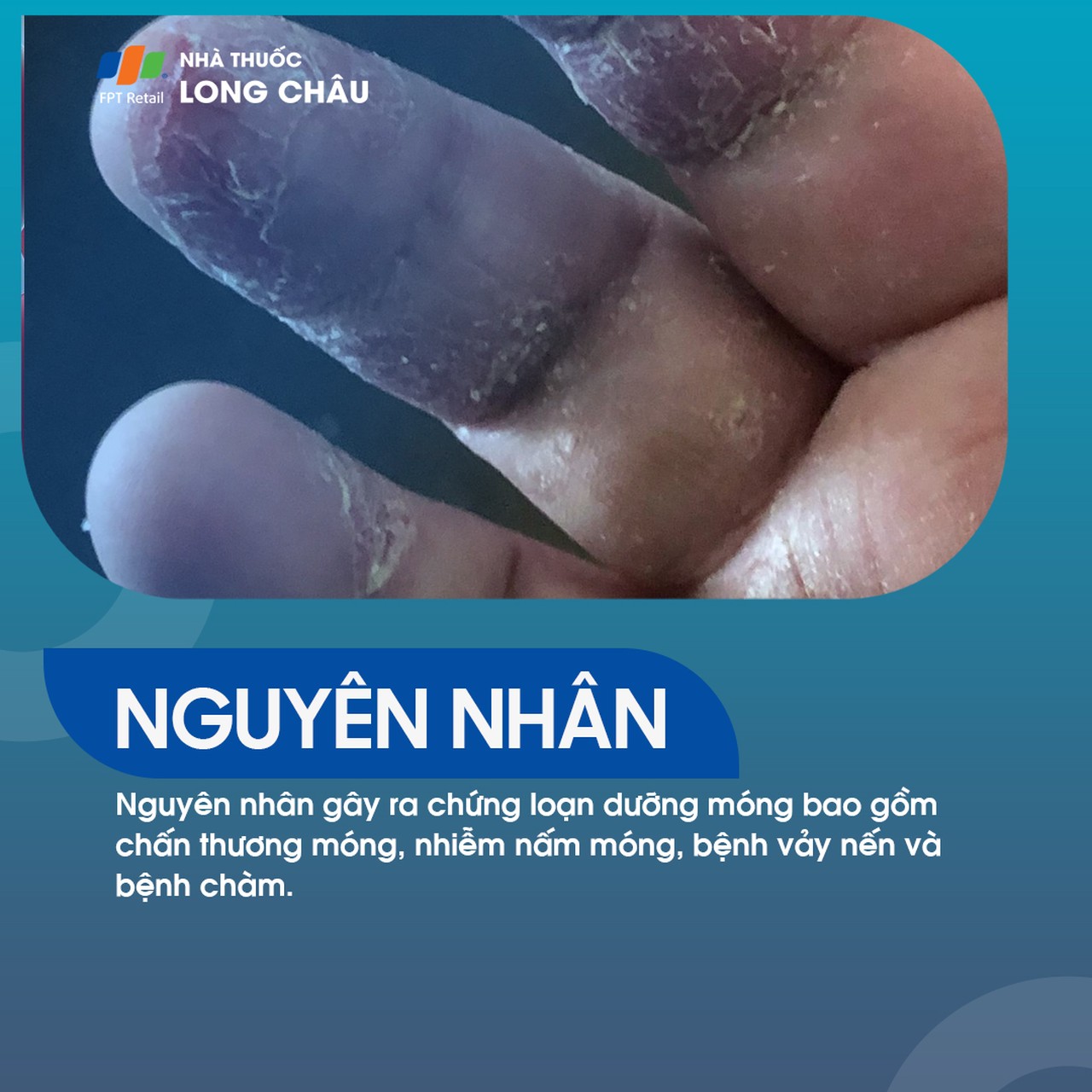 Loạn dưỡng móng 3