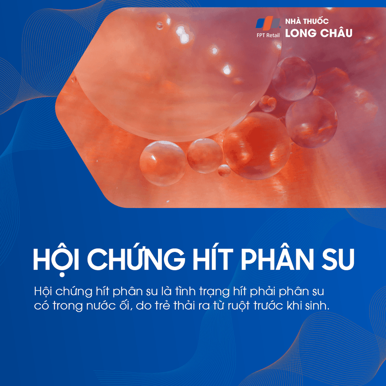 Hội chứng hít phân su 1