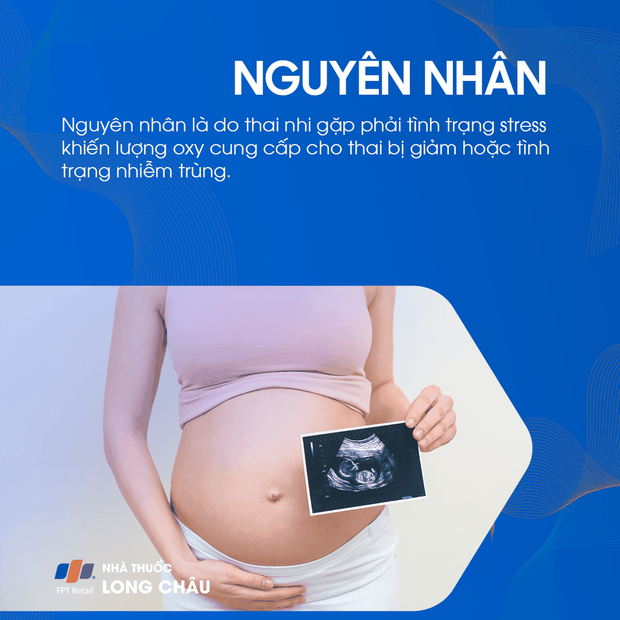 Hội chứng hít phân su 3