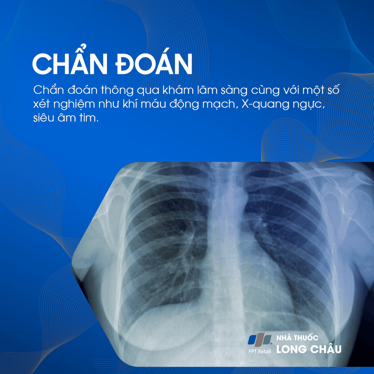 Hội chứng hít phân su 5