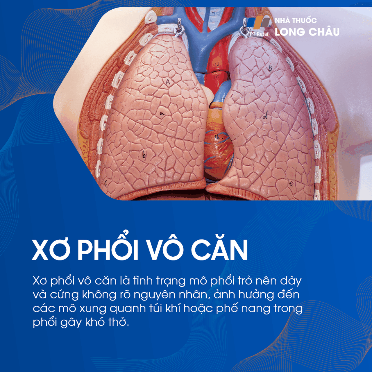 Xơ phổi vô căn 1