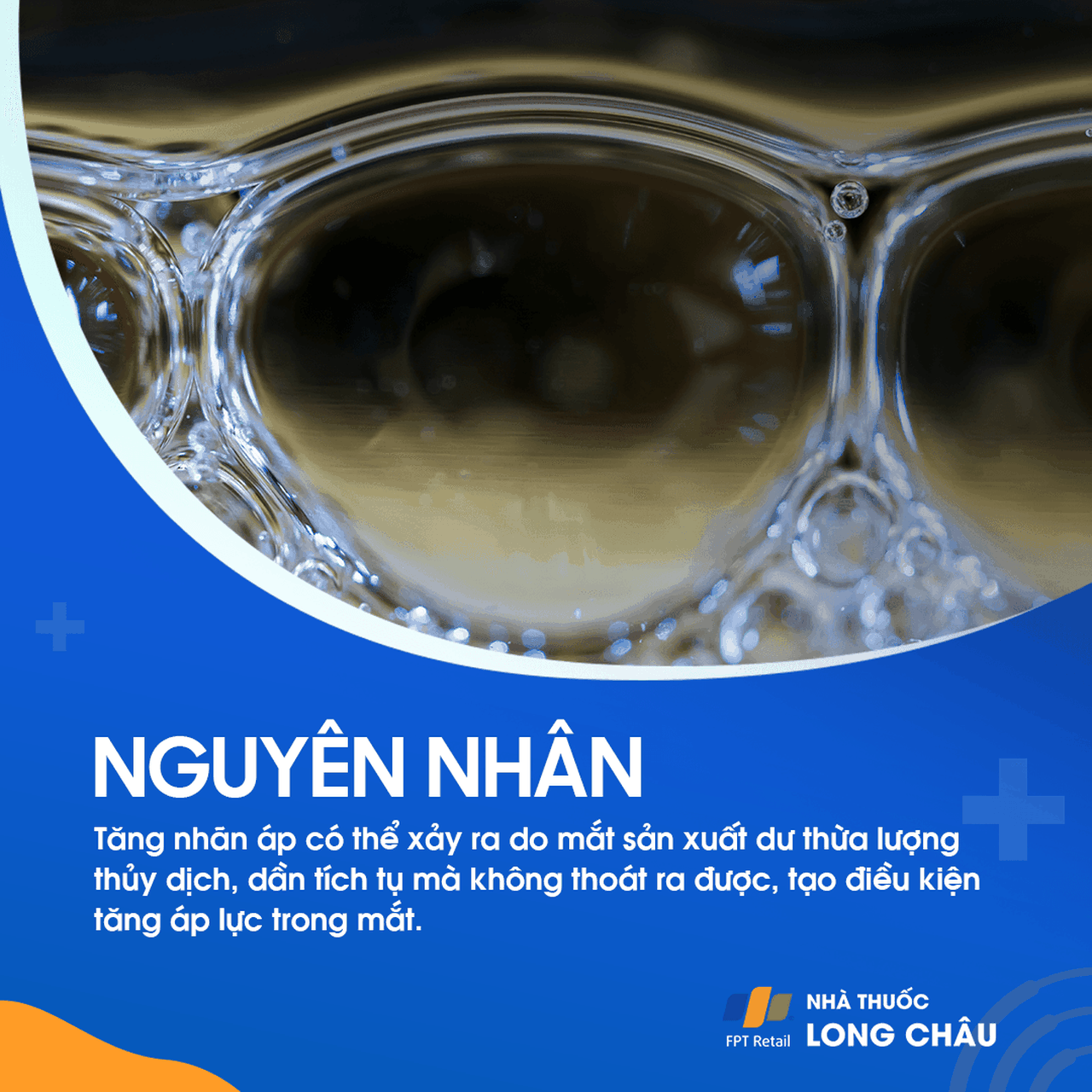  tăng áp lực trong nhãn cầu, nguyên nhân chính gây ra bệnh tăng nhãn áp