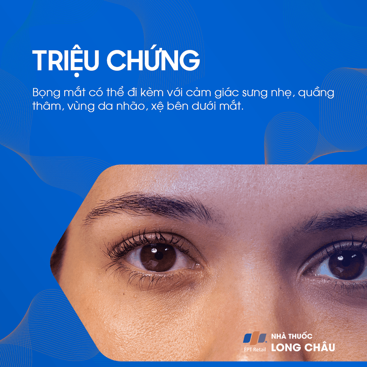 Triệu chứng bọng mắt: Sưng phù và bầm dưới mắt