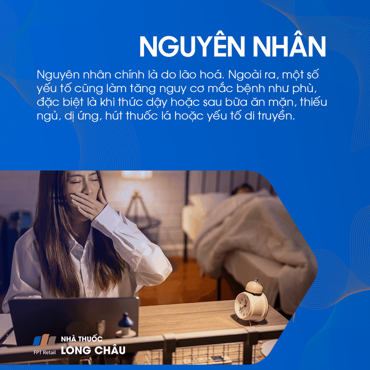 Nguyên nhân gây bọng mắt: Hình ảnh giải thích về ảnh hưởng của thiếu ngủ và căng thẳng