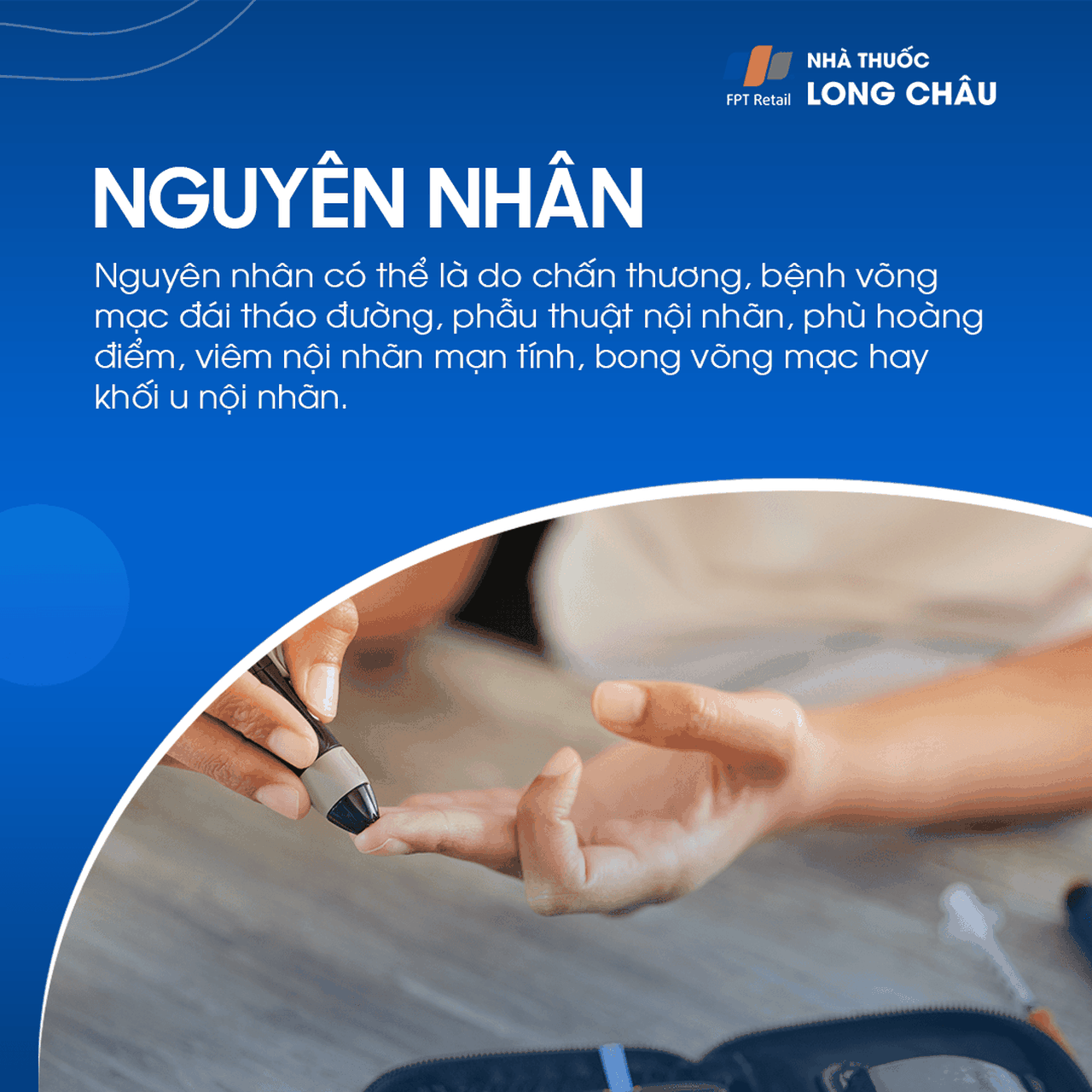 Màng trước võng mạc 3