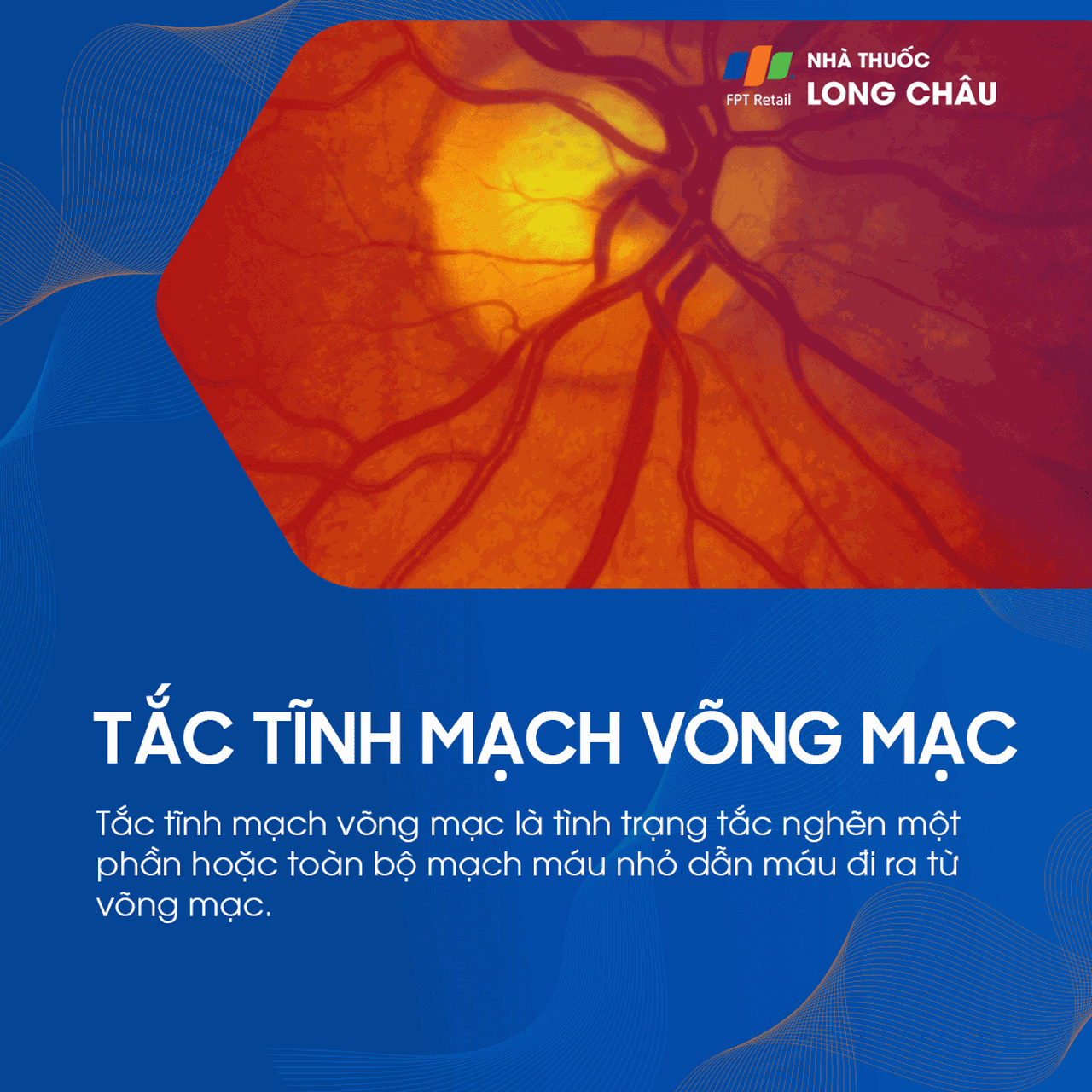 tắc tĩnh mạch võng mạc 1