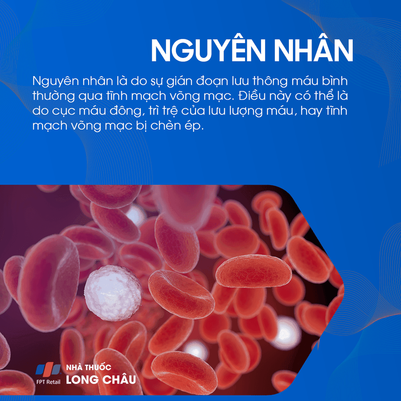 Tắc tĩnh mạch võng mạc 3