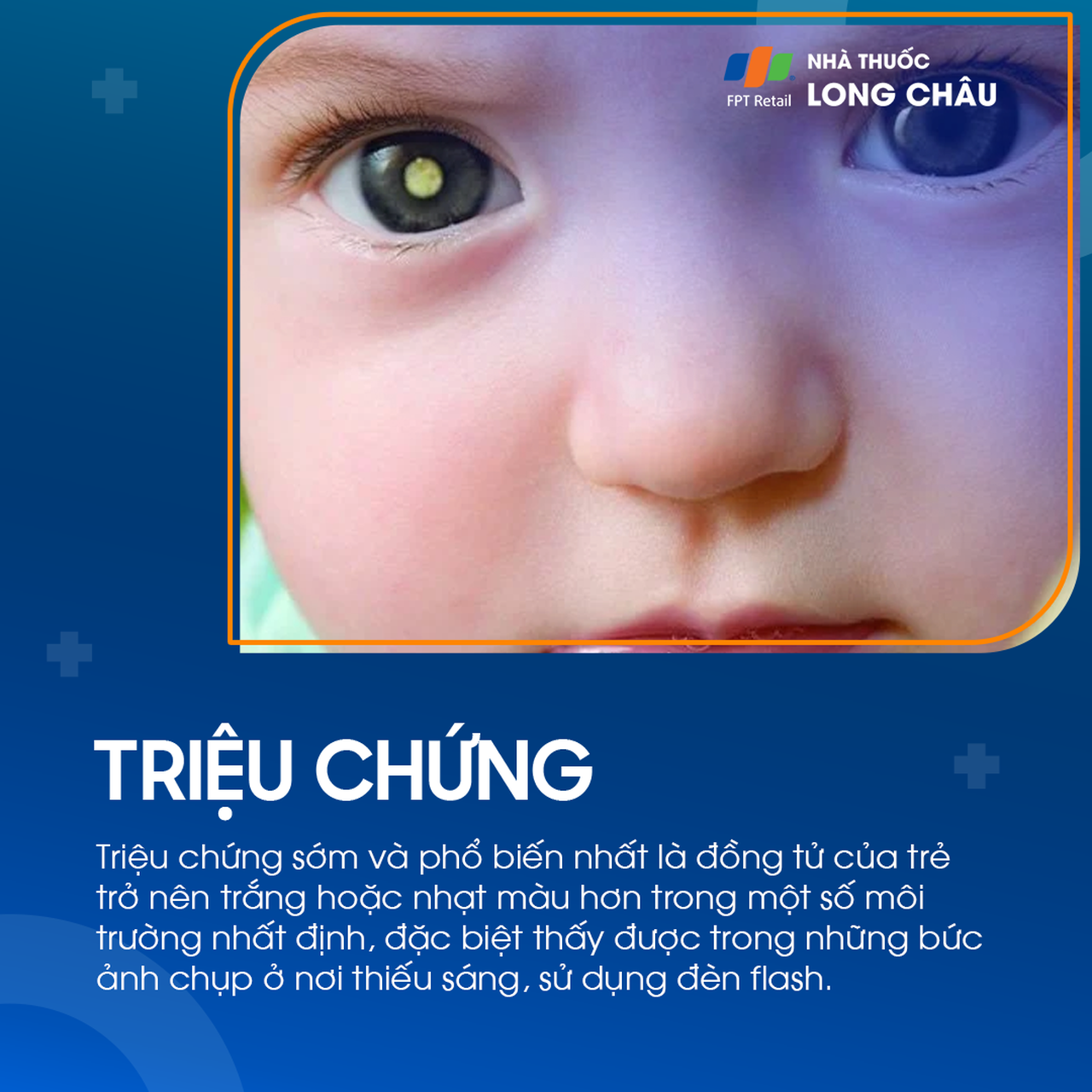 U nguyên bào võng mạc 2