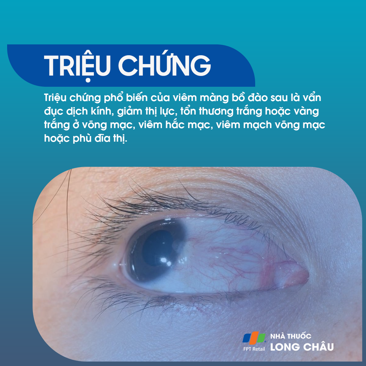 Viêm màng bồ đào 2