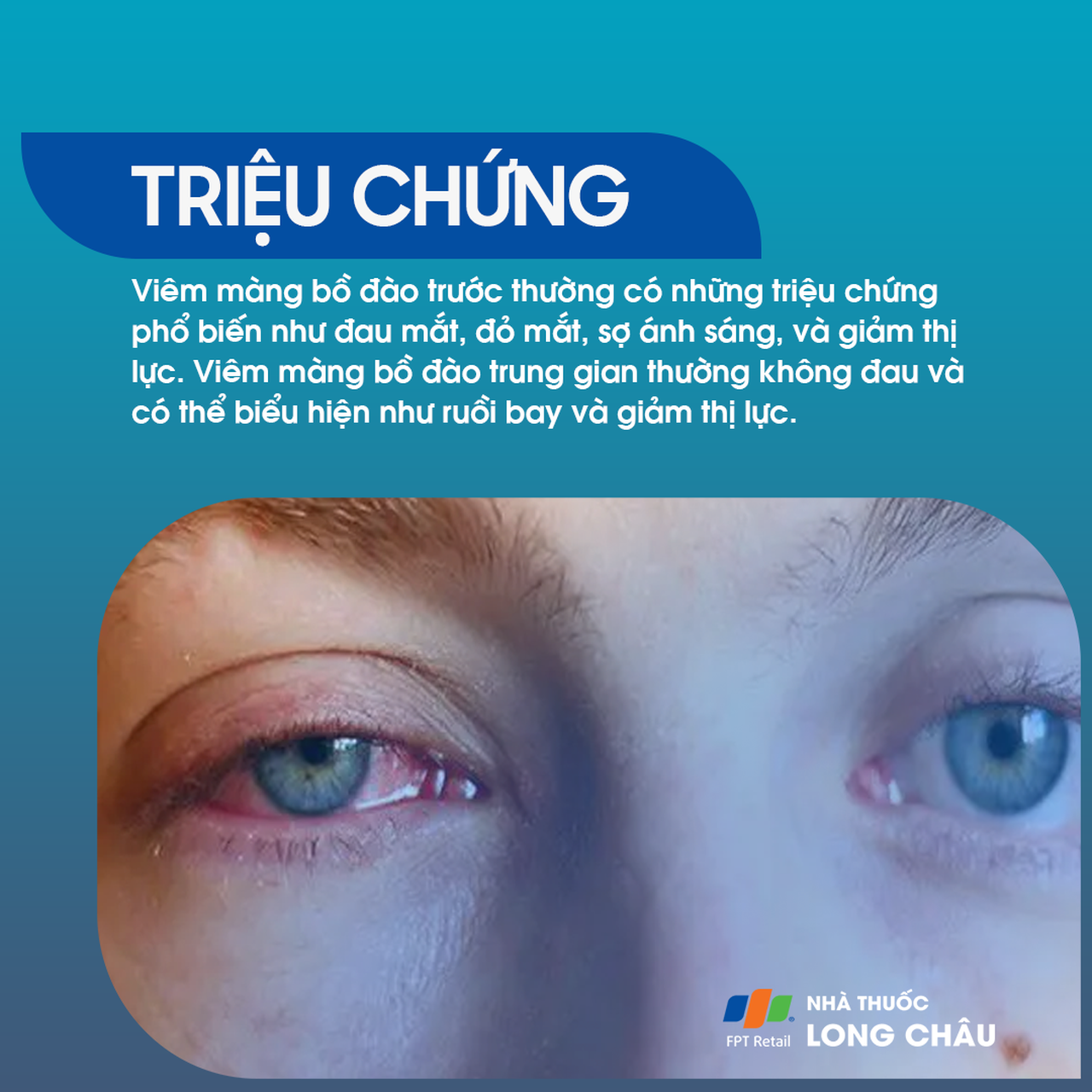 Viêm màng bồ đào 3