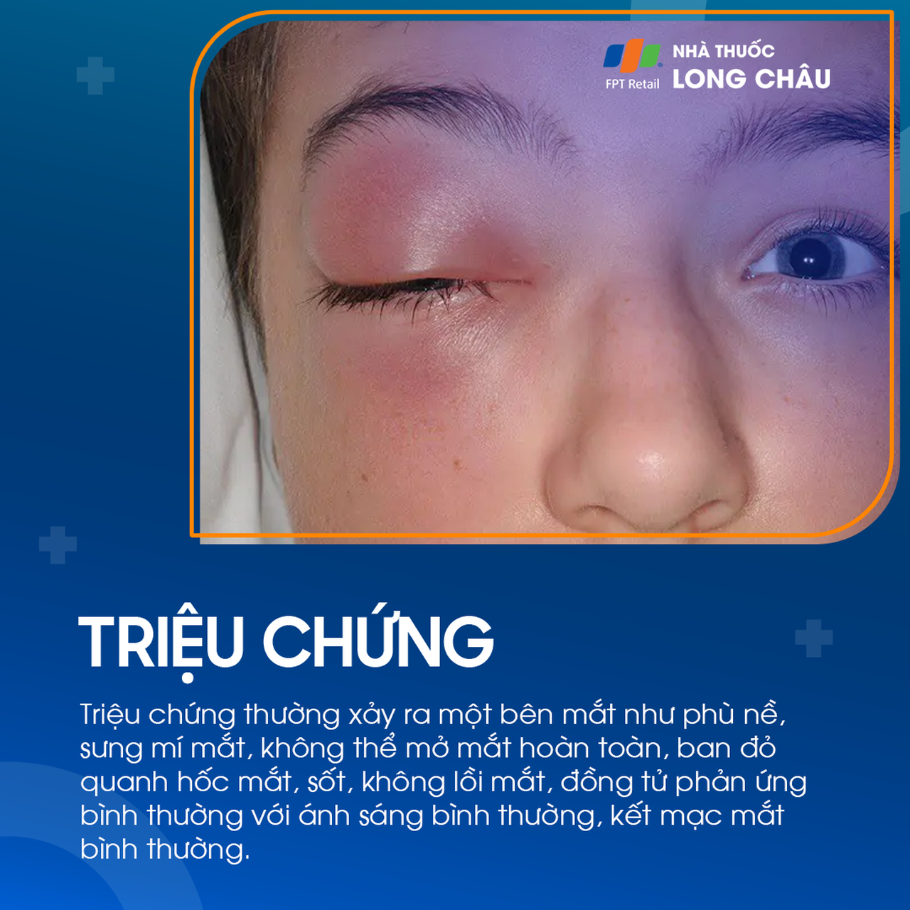 Viêm mô tế bào quanh hốc mắt 2