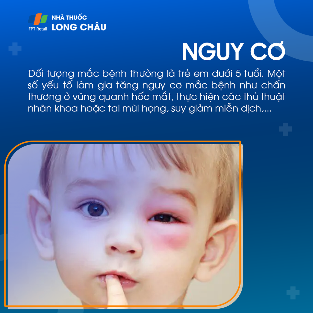 Viêm mô tế bào quanh hốc mắt 4