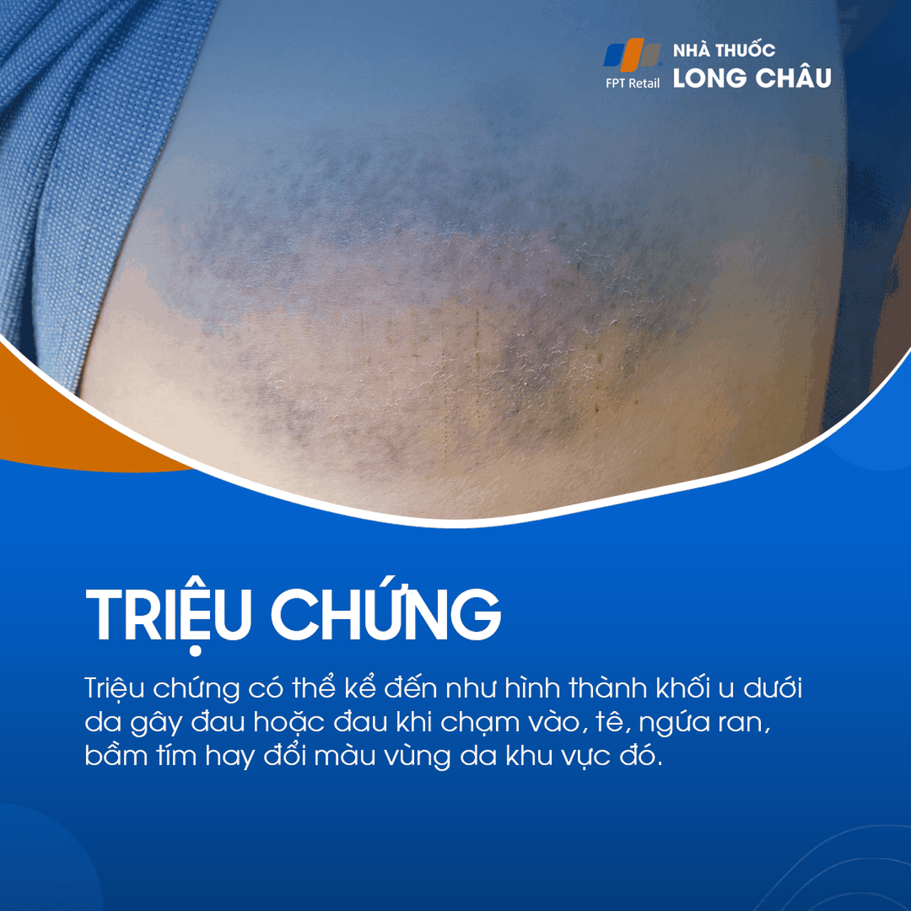 Giả phình mạch 3