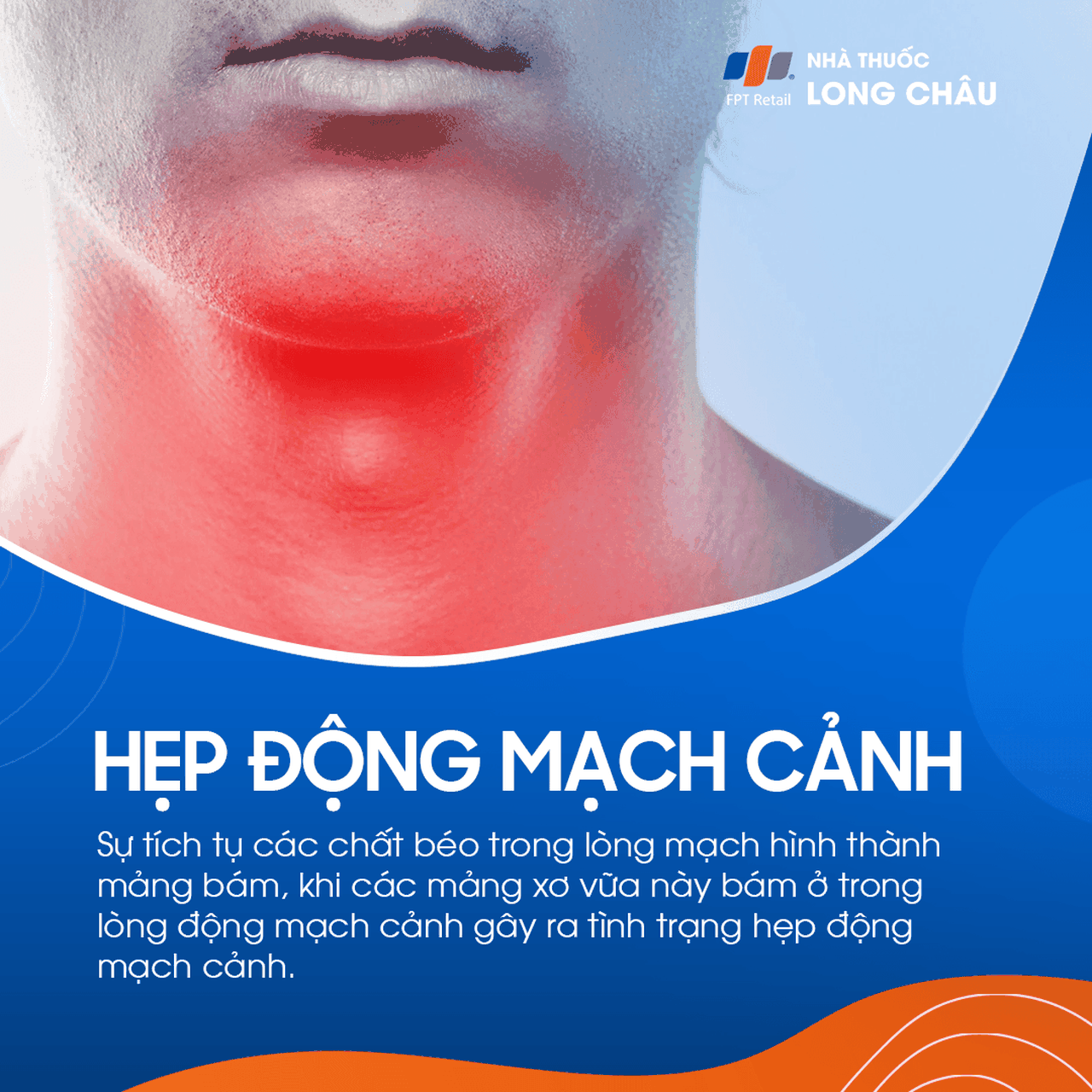 Hẹp động mạch cảnh 1
