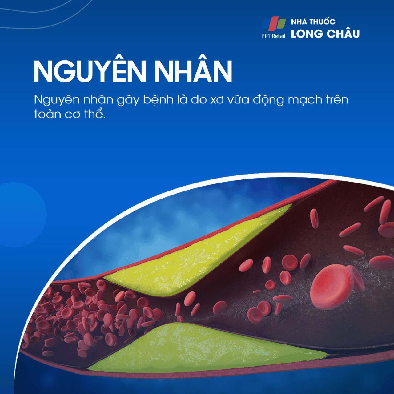 Hẹp động mạch cảnh 3