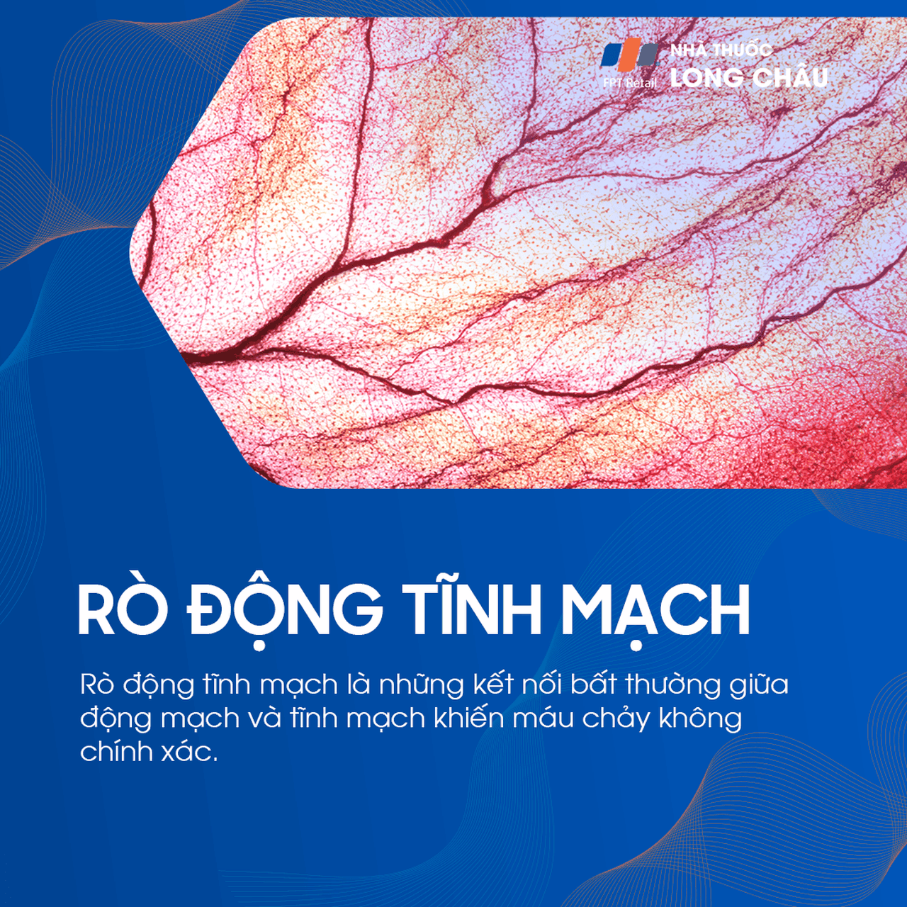 rò động tĩnh mạch 1
