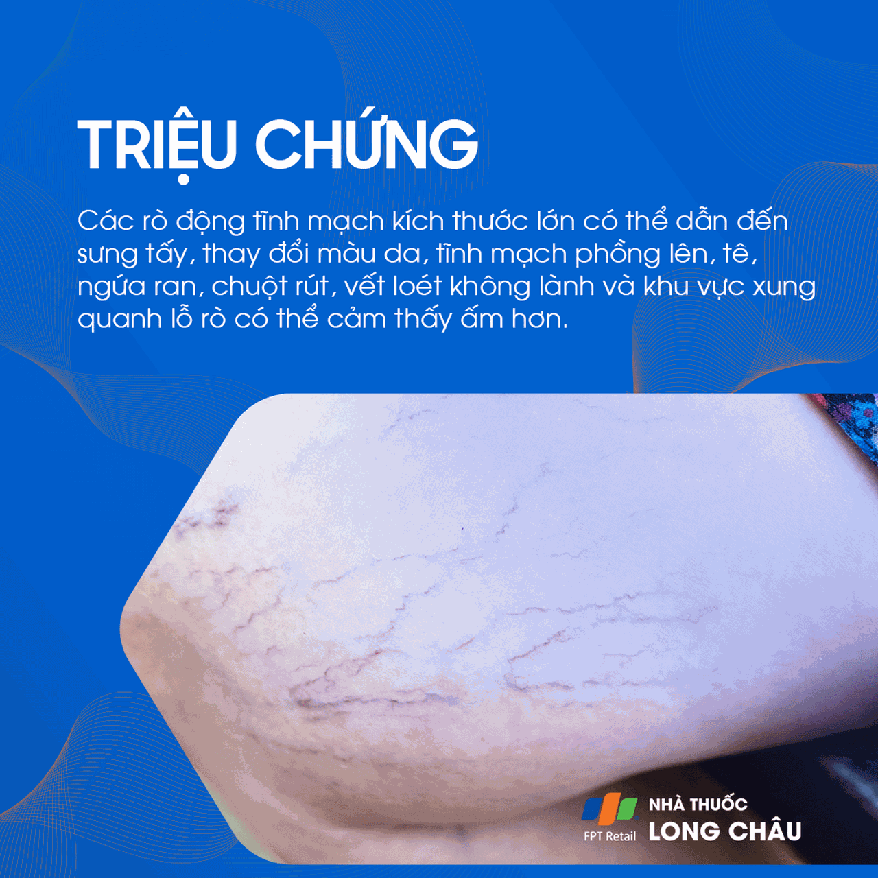 Rò động tĩnh mạch 2