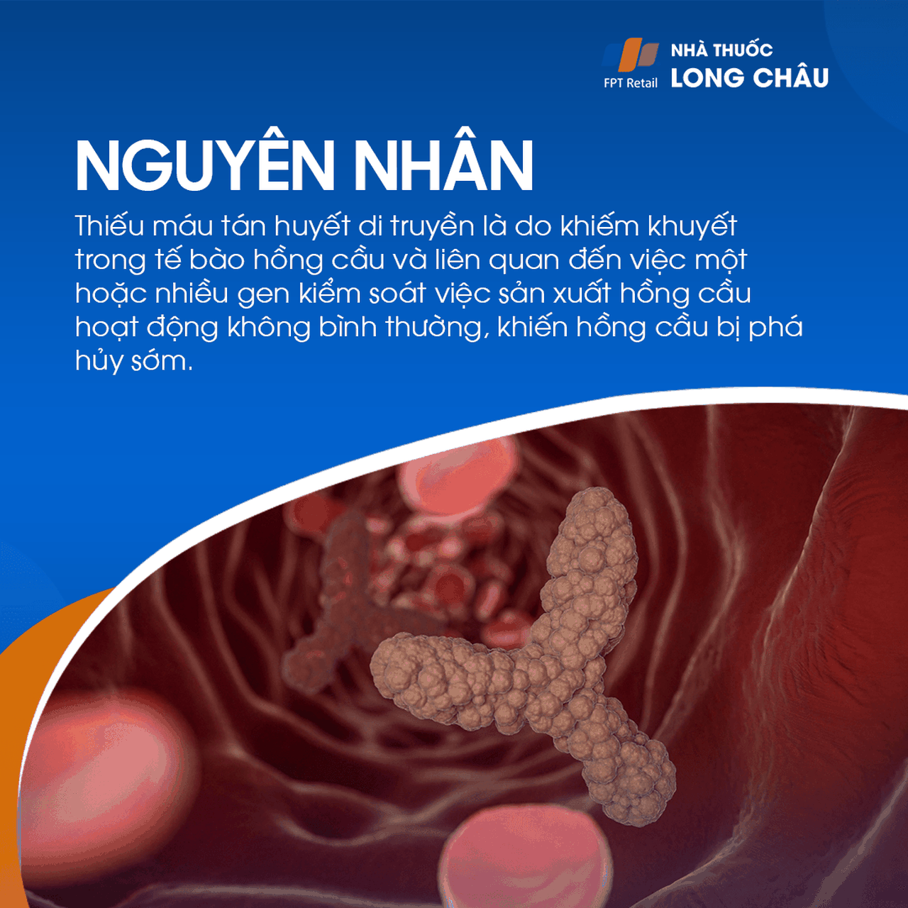 Thiếu máu tán huyết 4