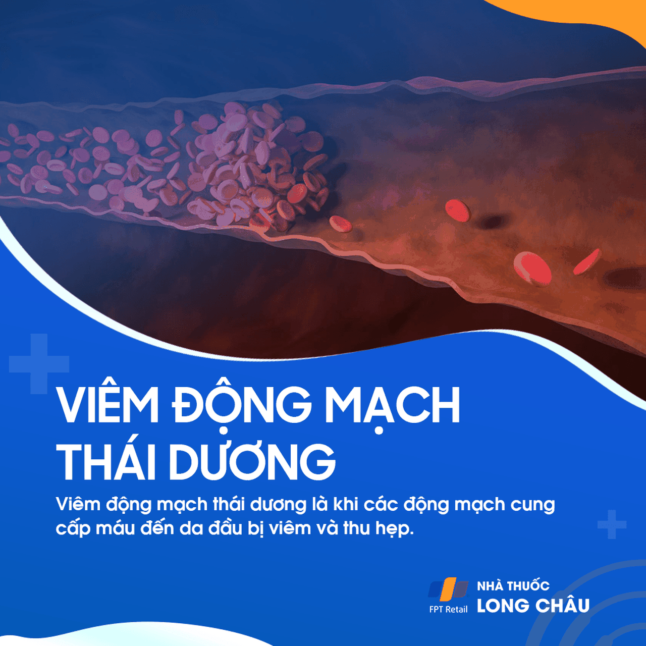 Viêm động mạch thái dương 1