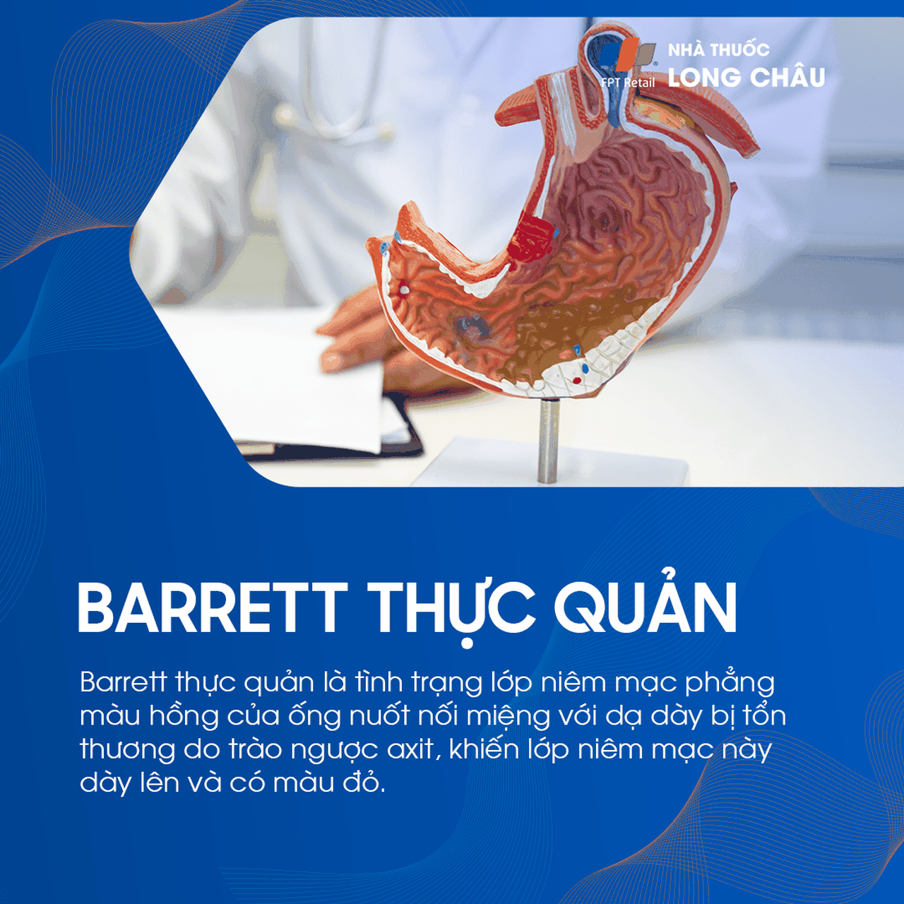 Barrett thực quản 1