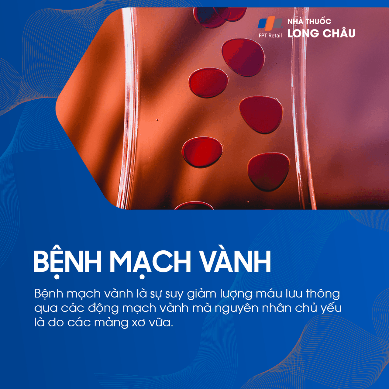 Mạch vành bị hẹp do mảng xơ vữa làm cản trở lưu thông máu