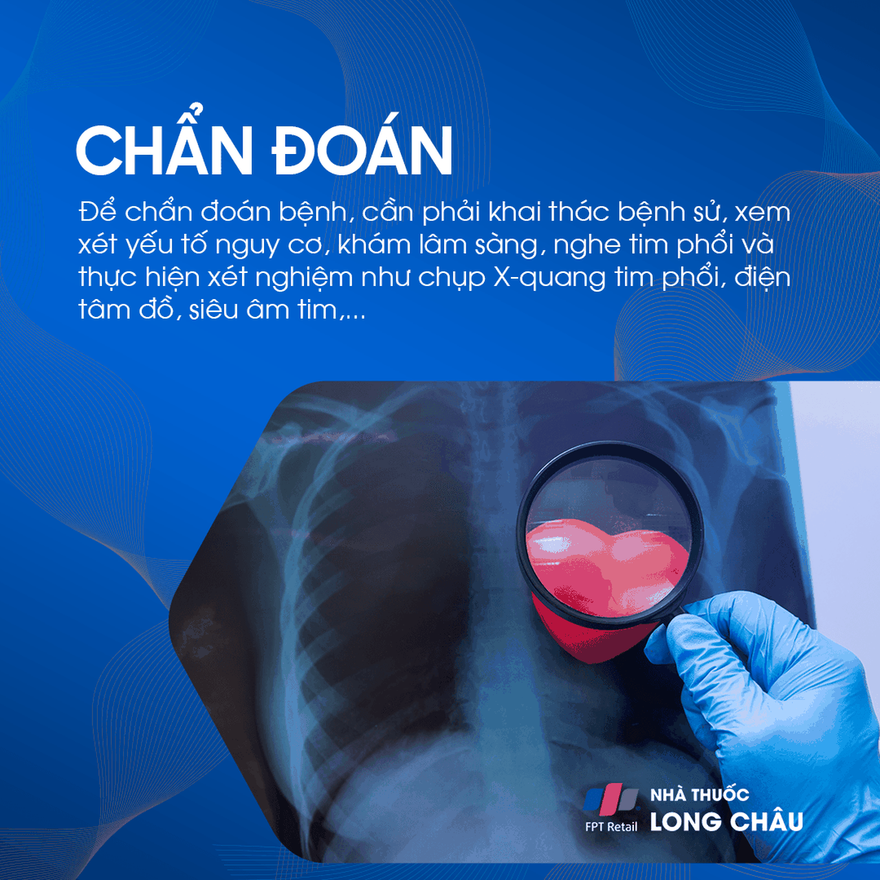 Phim X-quang tim phổi được soi qua kính lúp, minh họa các bước chẩn đoán bệnh mạch vành