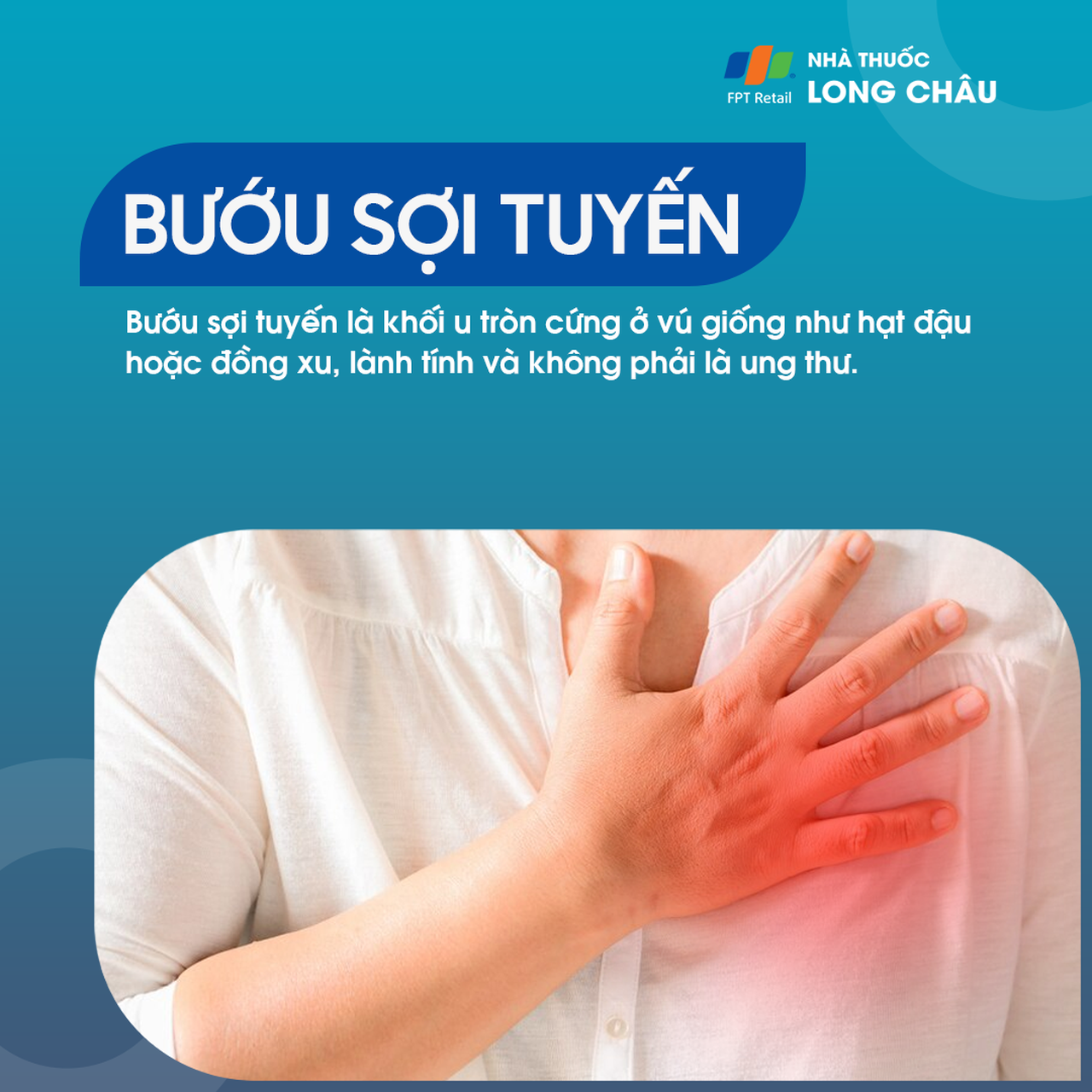 Bướu sợi tuyến 1