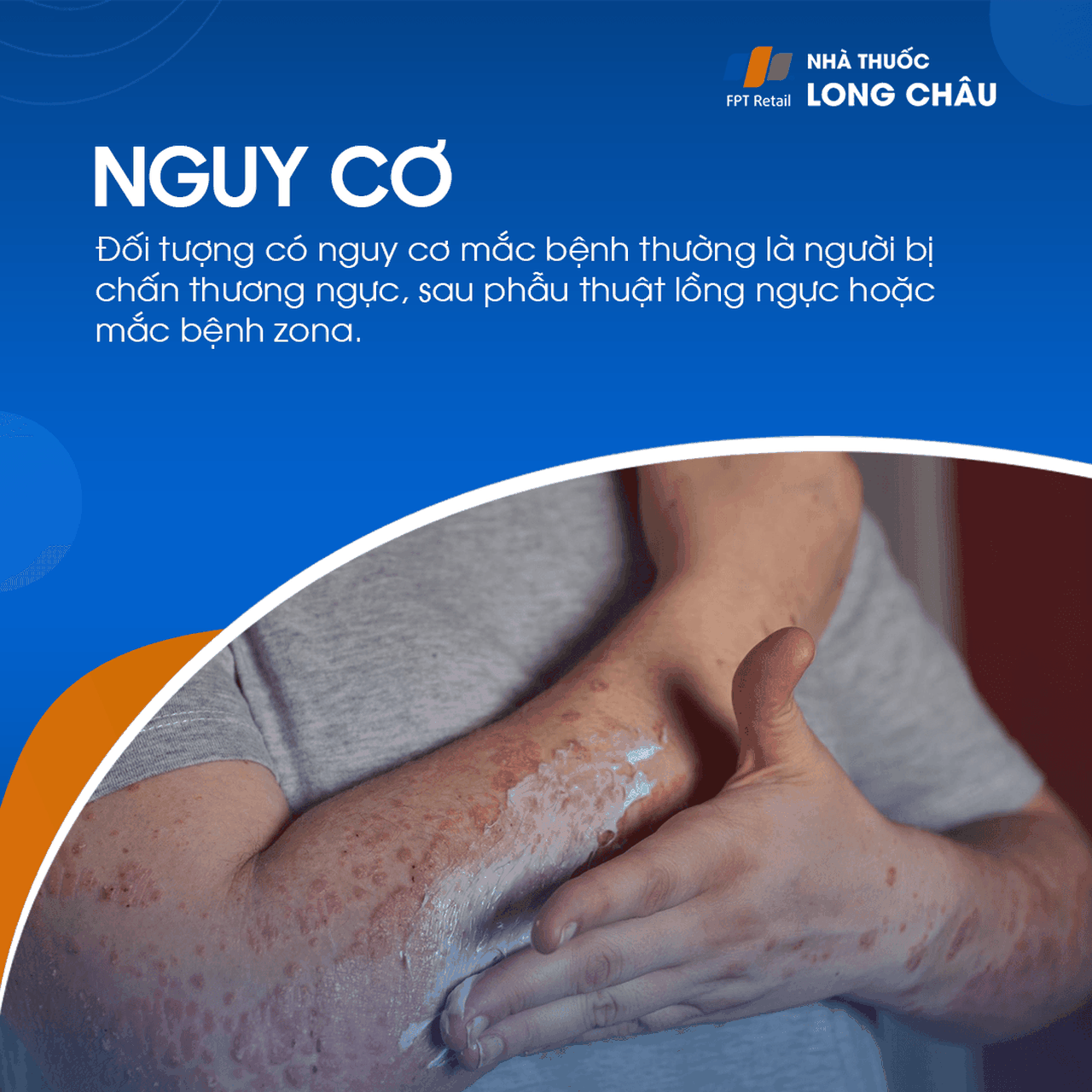 Nhóm người có nguy cơ cao bao gồm vận động viên, người lao động nặng