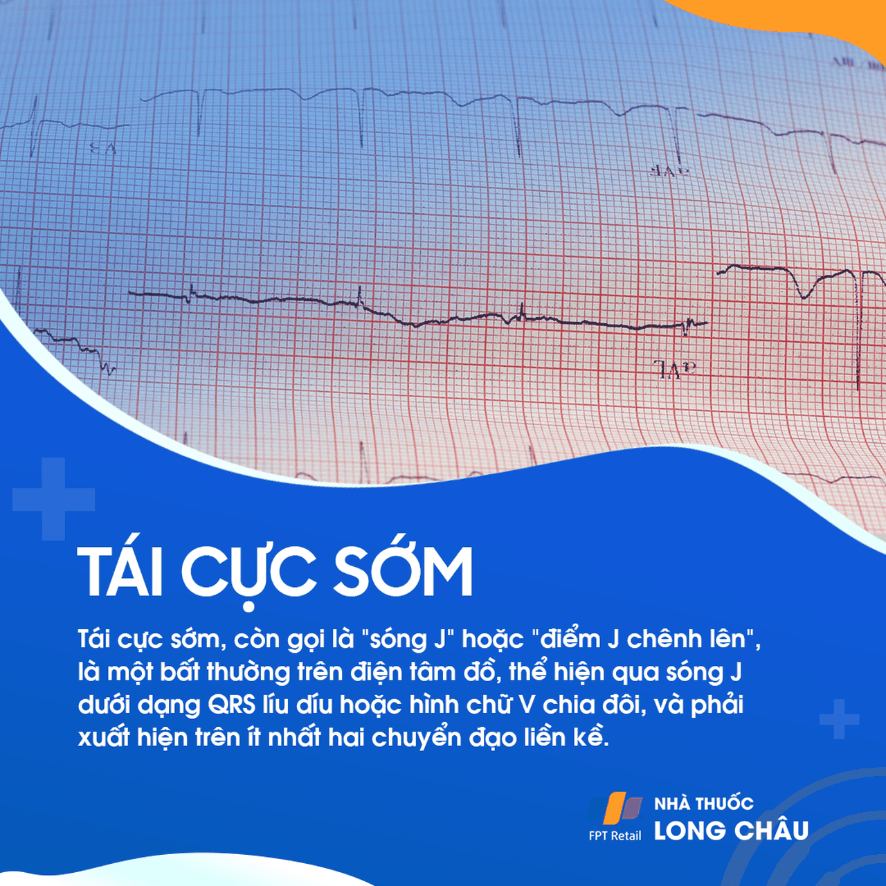 Tái cực sớm 1