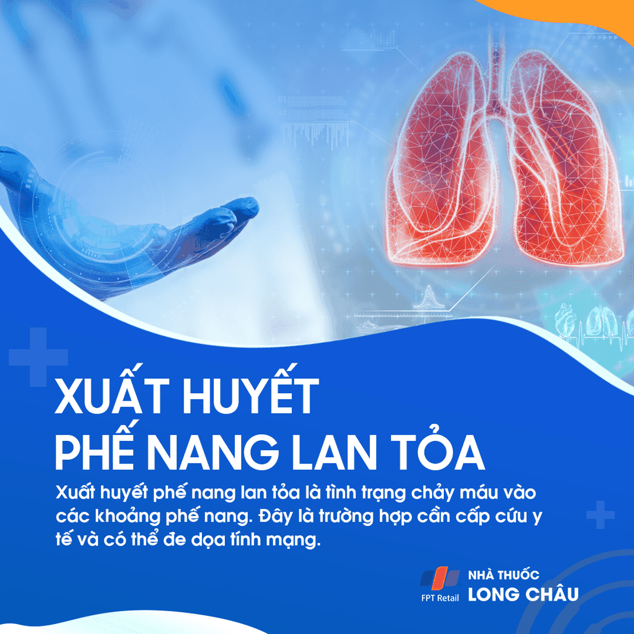 Xuất huyết phế nang lan tỏa 1