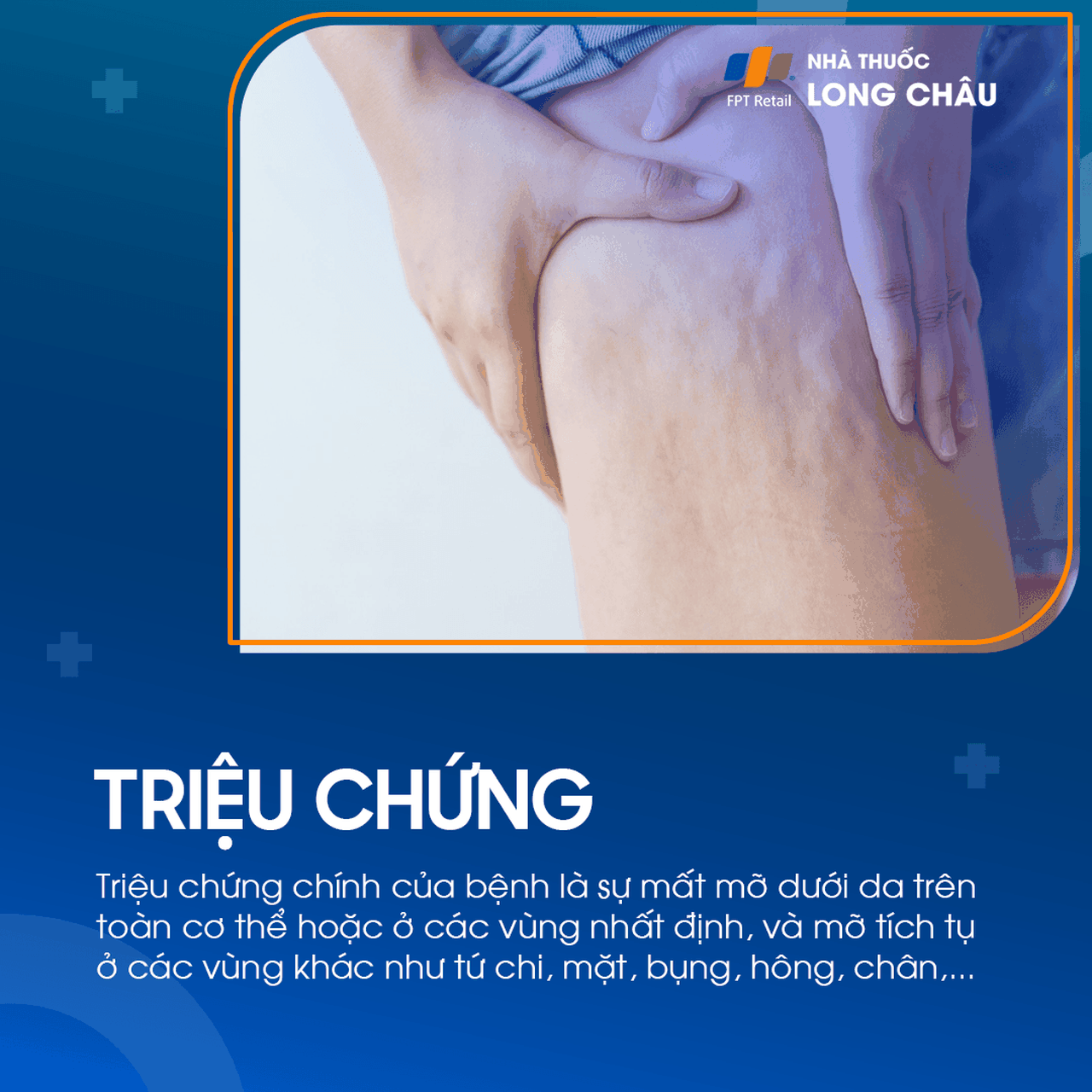 Loạn dưỡng mỡ 2