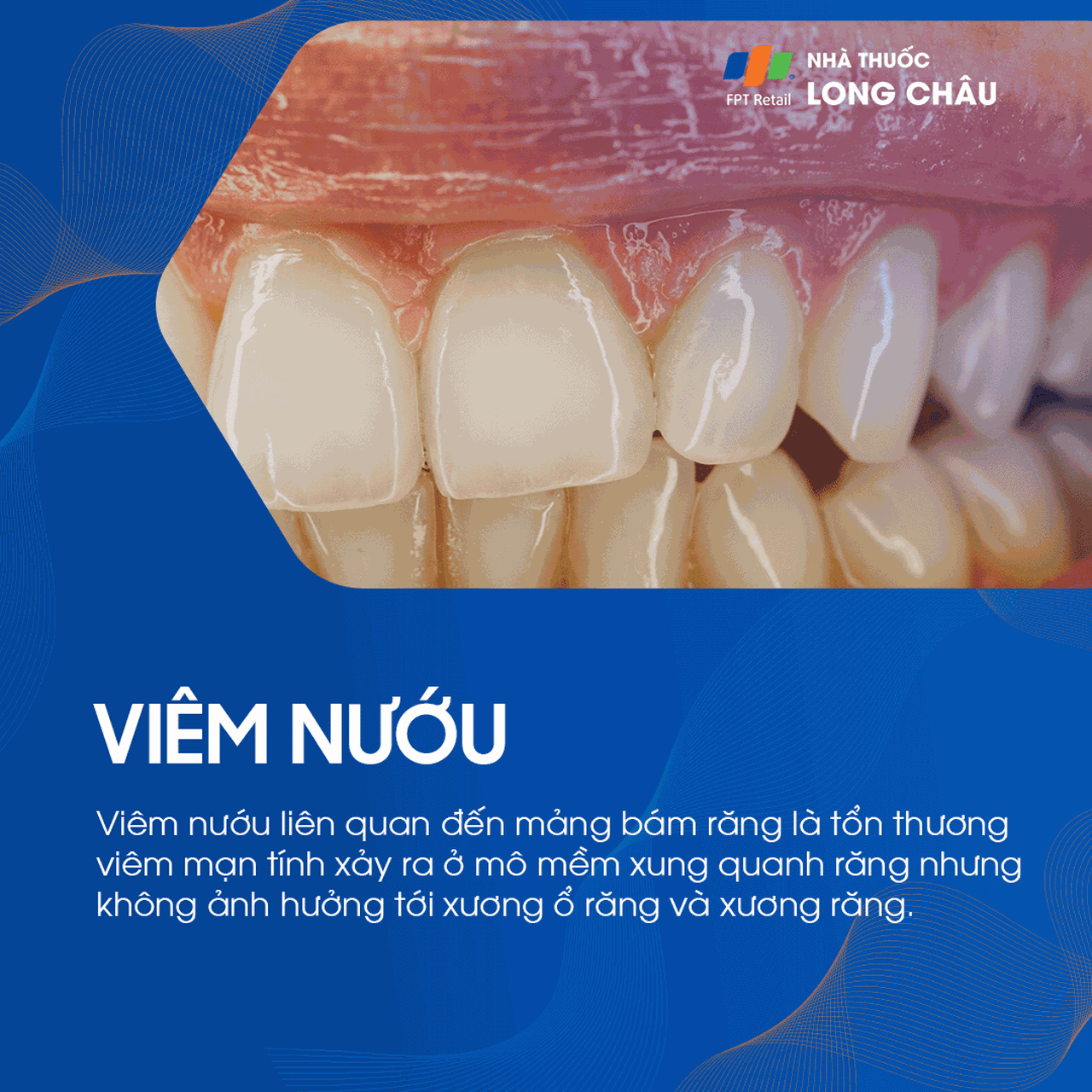 Bệnh nướu và nha chu 2