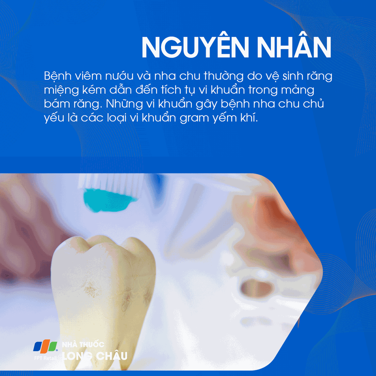 Bệnh nướu và nha chu 5