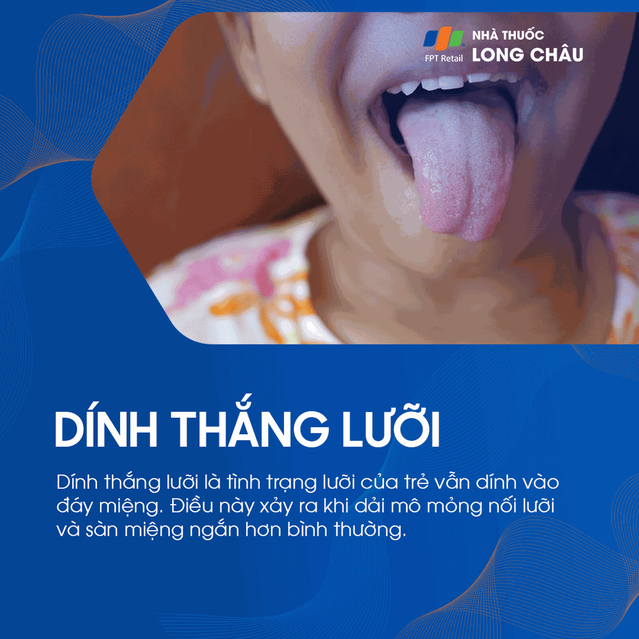 Dính thắng lưỡi 1
